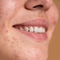 Fluttuazioni ormonali negli adolescenti: cause dell'acne