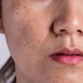 Inquinamento e acne: una panoramica completa