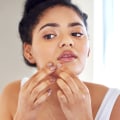 Comprensione dei cosmetici e dei prodotti per la cura della pelle - Cause dell'acne