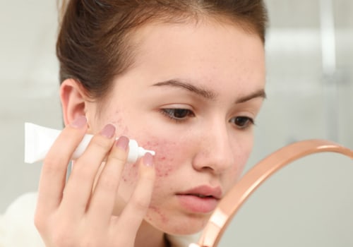 Comprensione degli squilibri ormonali e dell'acne