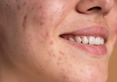 Fluttuazioni ormonali negli adolescenti: cause dell'acne