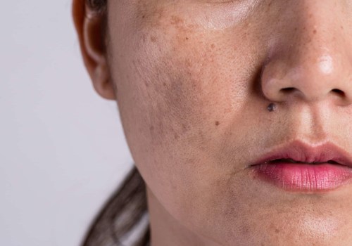 Inquinamento e acne: una panoramica completa