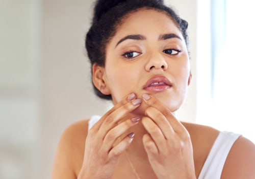 Comprensione dei cosmetici e dei prodotti per la cura della pelle - Cause dell'acne