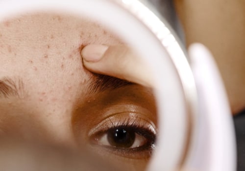 L'impatto dello stress e degli ormoni sull'acne